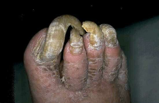 ongles