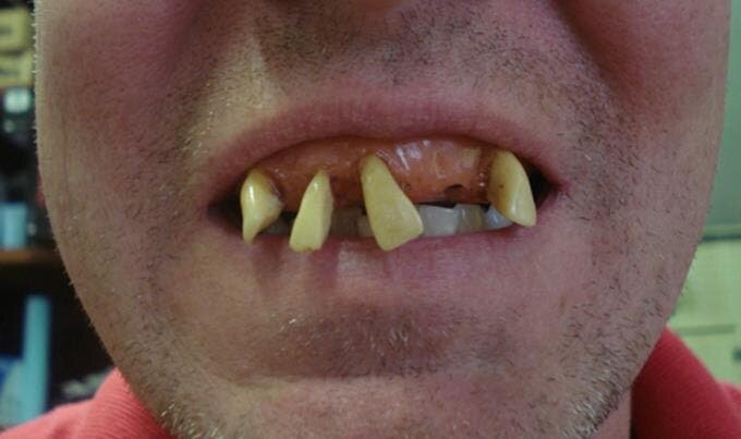 billy bob teeth