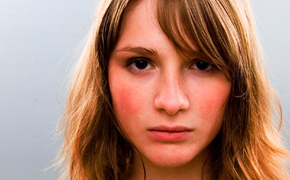 femme visage rougeurs