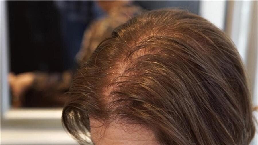 cheveux, perte, femme