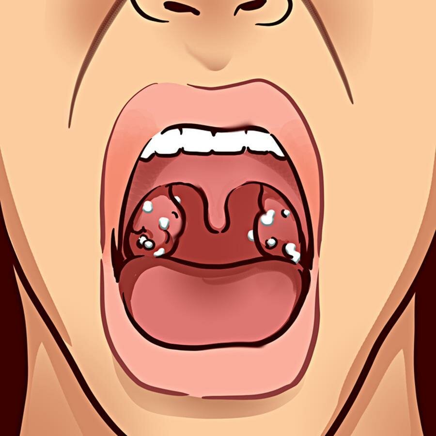 dessin, bouche, infection