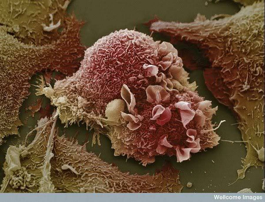 poumon, cancer, microscope