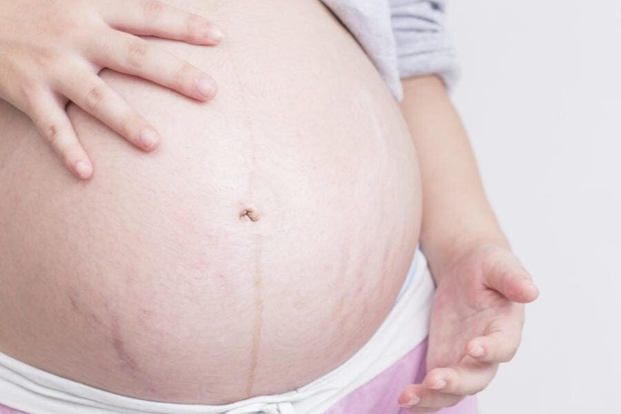 vergeture, ventre, enceinte, grossesse