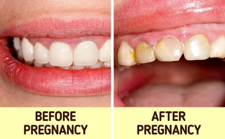 dents bouche carie