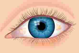 oeil, tâche, jaune