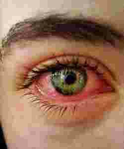 yeux, rouge, fatigue