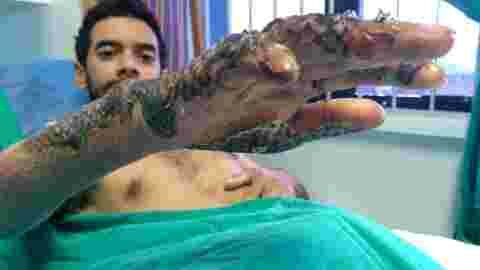 patient ,bresil, brulure