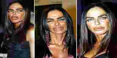 27 photos qui prouvent que la chirurgie esthétique peut être une très mauvaise idée